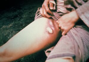 Bubonic plague - House MD